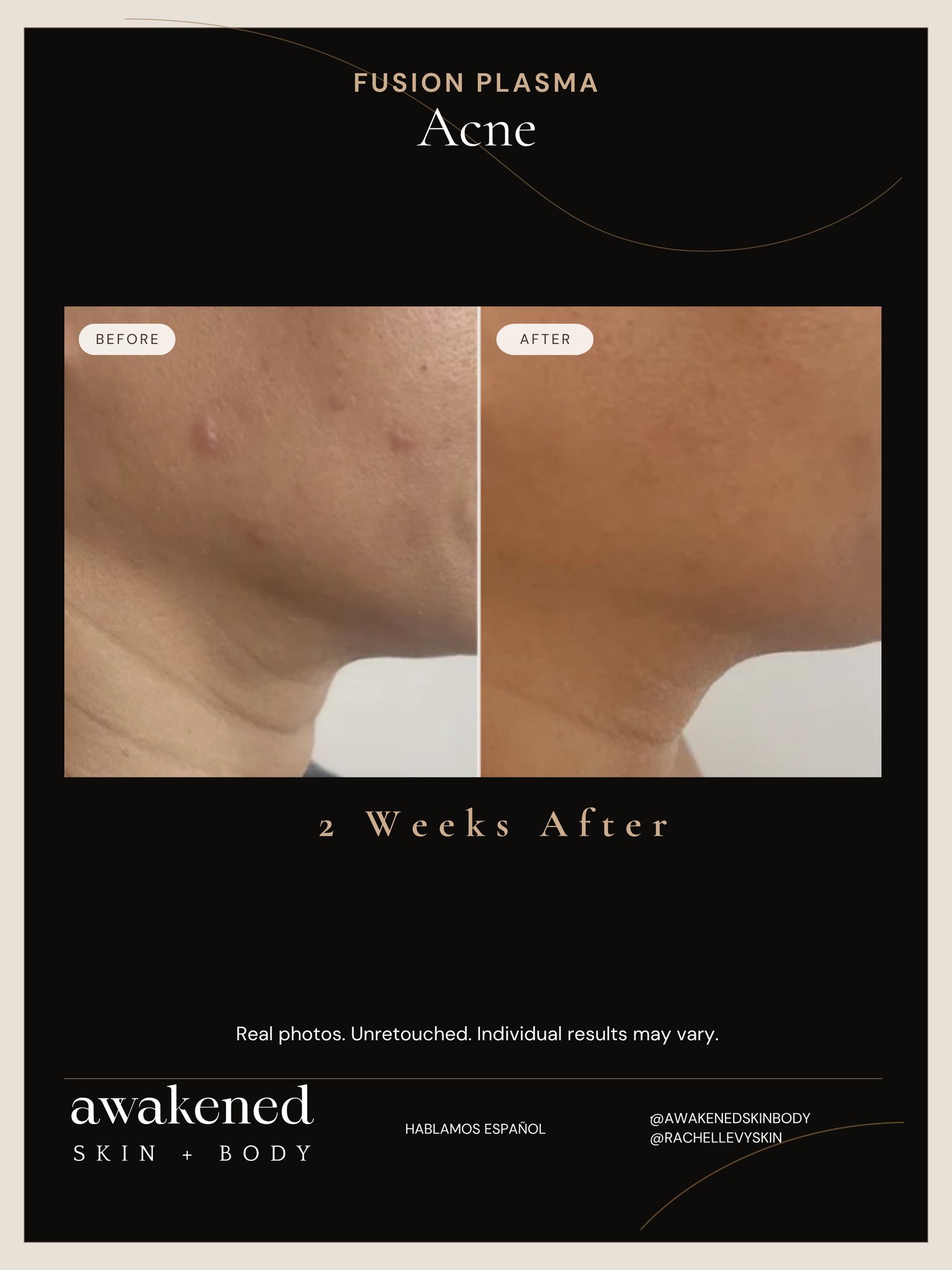 Active acne fully healed, before and after