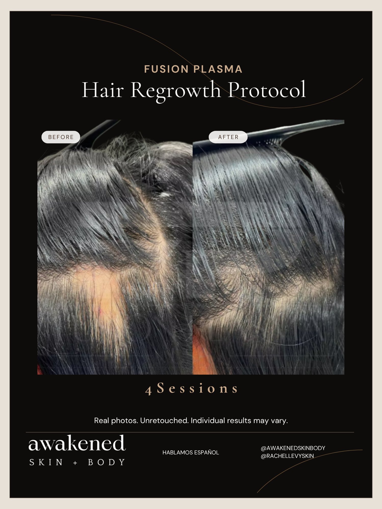 Hair density recovery, before and after