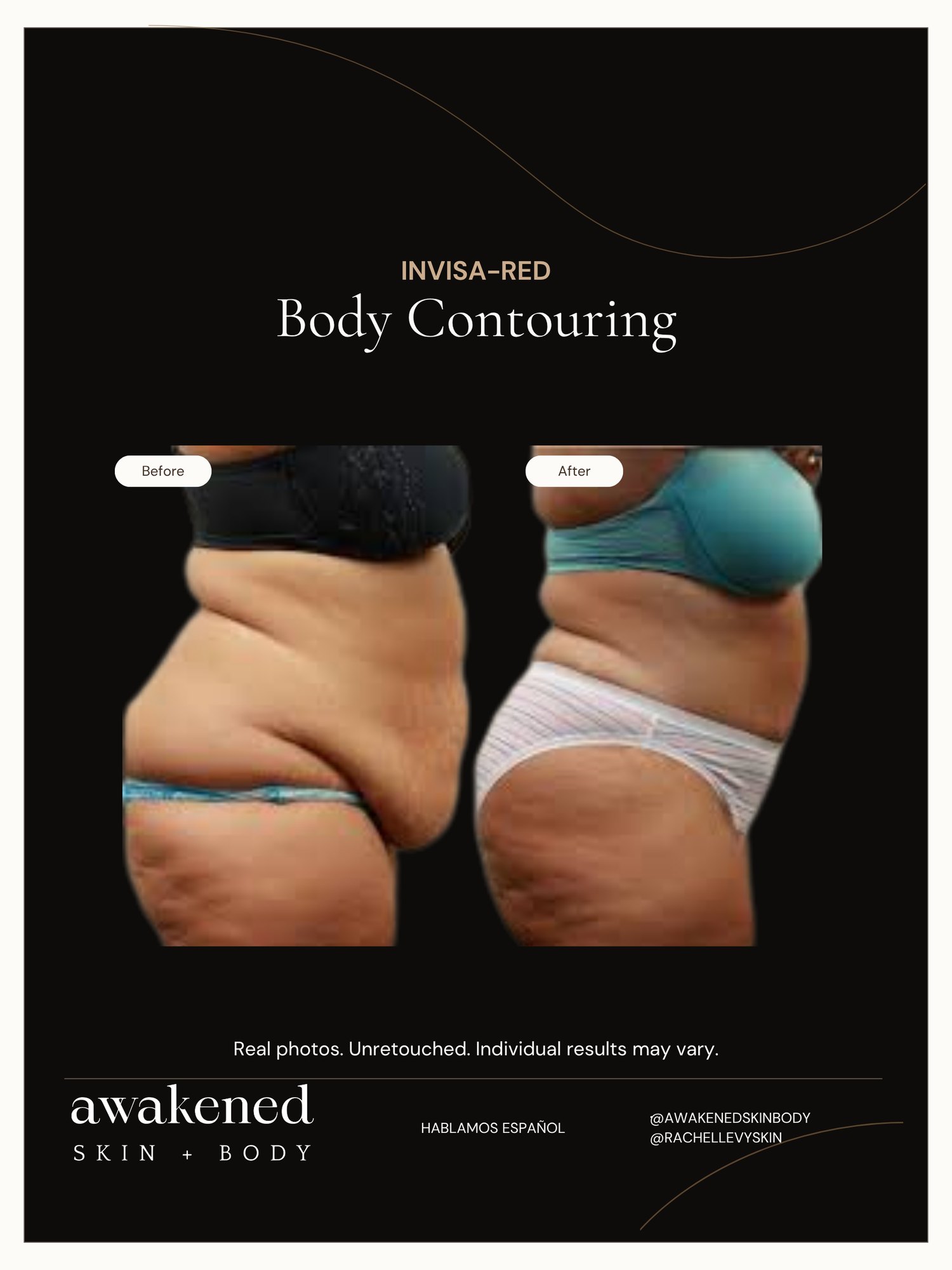 Body contouring before and after, Invisa-RED program